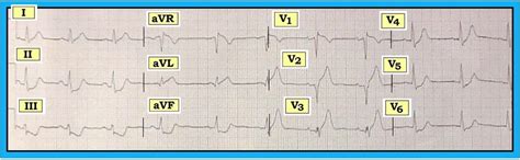 Normal stemi morphology may precede or follow the dewinter pattern. ECG Interpretation: ECG Interpretation Review #53 (Peaked ...