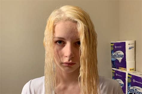 Teen S Hair Melts And Falls Out After Home Bleaching Goes Disastrously