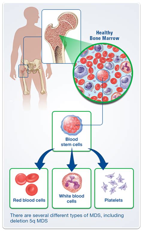 Mds Patient What Is Del 5q Syndrome Diagnosis Healthy Bones