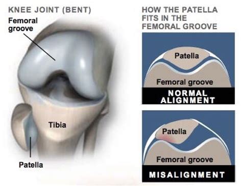 Pin On Patellar Tracking Disorder