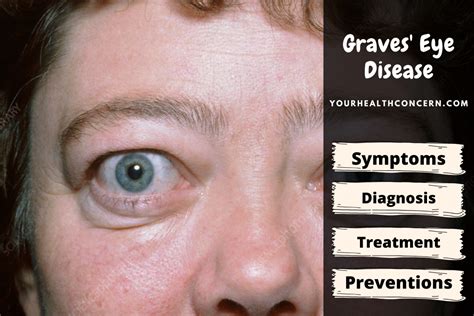 Graves Eye Disease Symptoms Diagnosis And Treatment