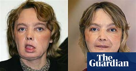 Transplant Woman Tells Of Her Life With A New Face World News The Guardian