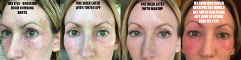 Under Eye Laser Treatment For Wrinkles Quotes Type