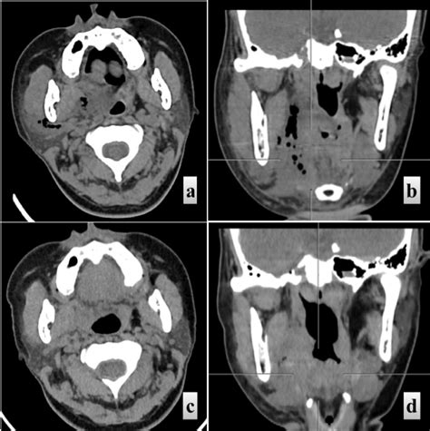 A Axial And B Coronal Plain Ct Scans Showing Multiple Abscesses And