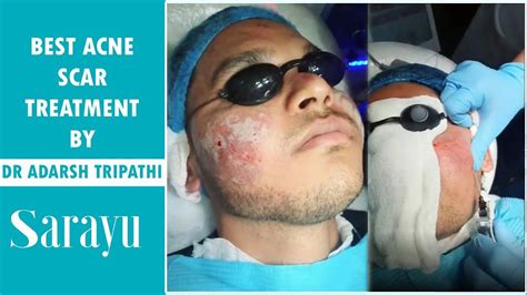Best Acne Scar Treatment In Delhi Facial Scar Removal Treatment Full