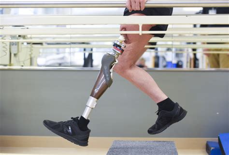 Osseointegration Surgery Gives Amputee Hope For Better And Stronger Life