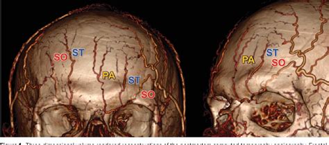 Figure From The Arteries Of The Central Forehead Implications For