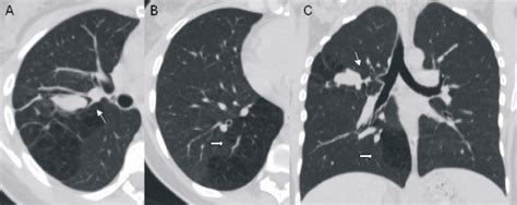 Congenital Cystic Adenomatoid Malformation Of The Lung
