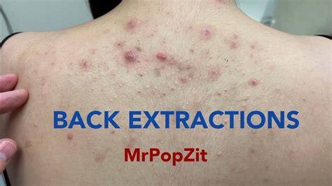 Tons Of Blackheads On The Back Acne Extractions Blackheads And