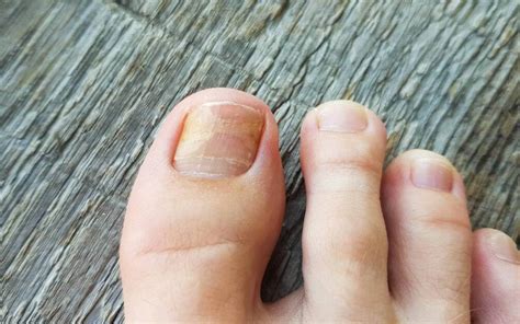 What Are The Best Toenail Fungus Treatments Scripps Health