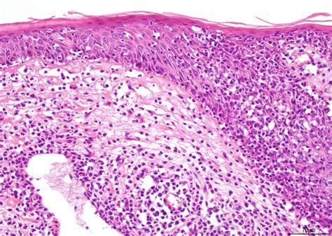 Pathology Outlines Lymphomatoid Papulosis