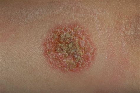 10 Dermatitis O Eczemas