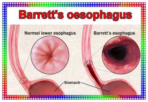 barretts esophagus and esophageal adenocarcinoma second edition gambaran