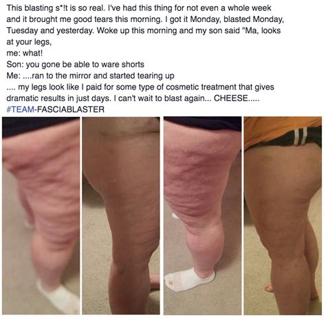 Pin On Cellulite Removal