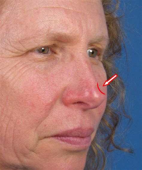 Skin Cancer Symptoms Nose
