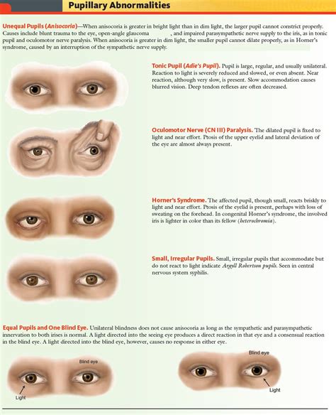 Pupillary Abnormalities Overview - Unequal Pupils 