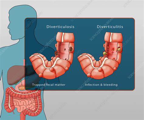 Diverticulosis And Diverticulitis Illustration Stock Image C039