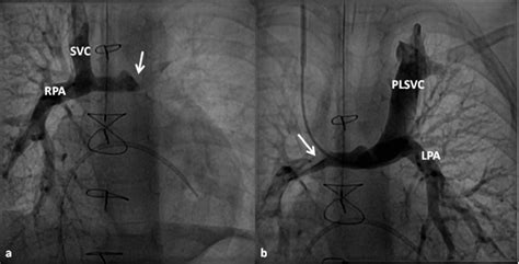 Selected Cineangiographic Frames Showing Bilateral Bidirectional Glenn