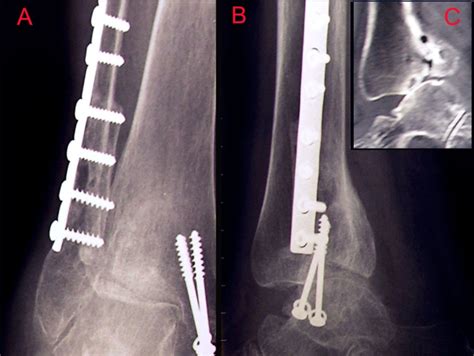 Arthroscopic Ankle And Subtalar Arthrodesis Indications And Surgical