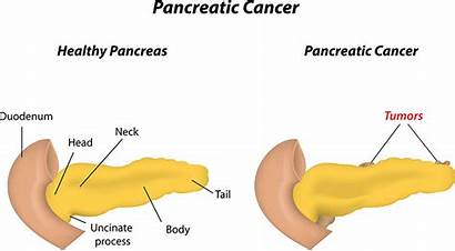 Pancreatic Cancer Types Treatment Causes Risk Factors