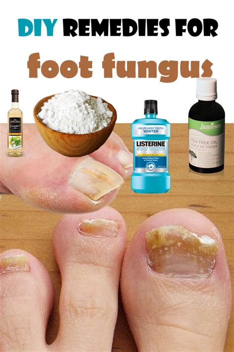 Diy Remedies For Foot Fungus Top Health Remedies