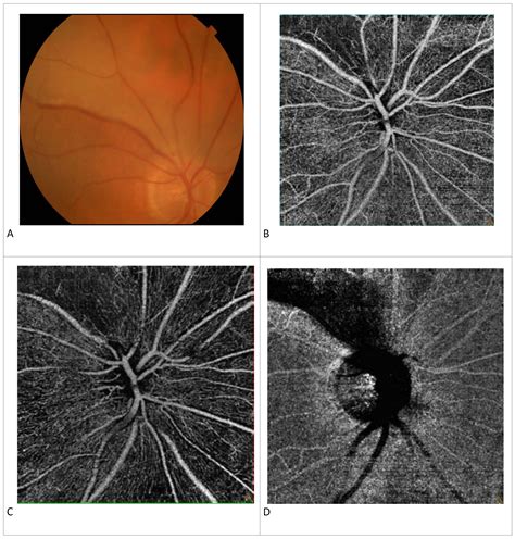 Acute Branch Retinal Artery Occlusion And Oct Angiography Imaging
