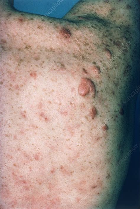 Acne Vulgaris Keloid Scars On A Mans Shoulder Stock Image M108