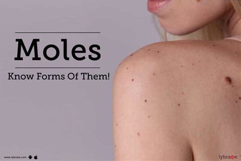 Moles Symptoms Causes And Ultimate Top 4 Factors
