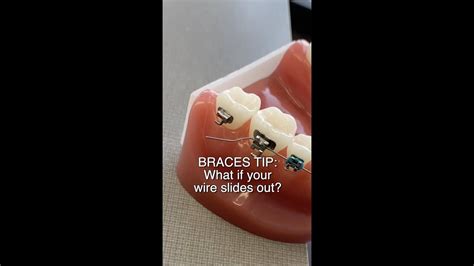 Braces Wire Poking Cheeks Or Gums Here S What To Do 🦷 Shorts Braces Tips Gum Braces