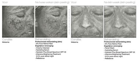 Pca Retinol Peeling Behandeling Bloy Institute In Amsterdam