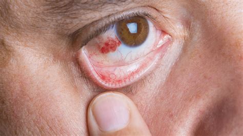Unam Investiga Bacterias Para Tratar Infecciones En Los Ojos Unam Global