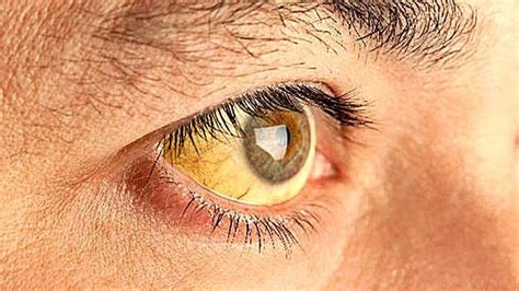 Si ves que el blanco de tus ojos se torna amarillo ésta podría ser la