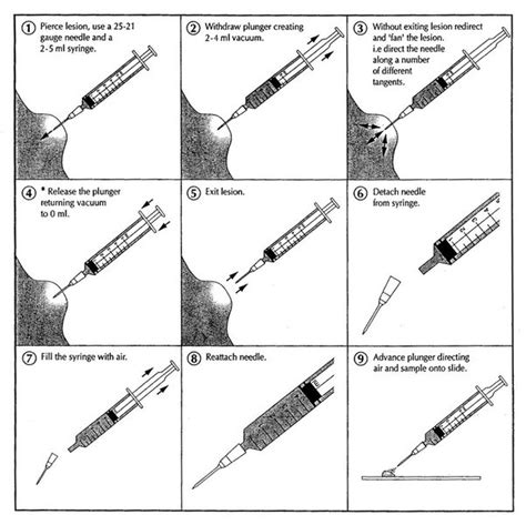 Fine Needle Aspiration Cytology Pdf Role Of Fine Needle Aspiration