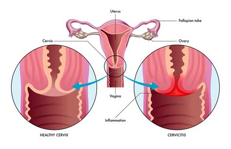 cervicitis harvard health