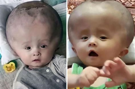 Baby Illness Boy Suffers From Huge Head And It Wont
