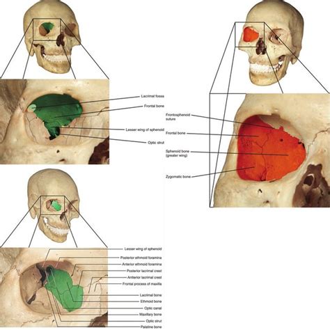 5 The Orbital Floor In A Frontal View Demonstrating The A Orbital