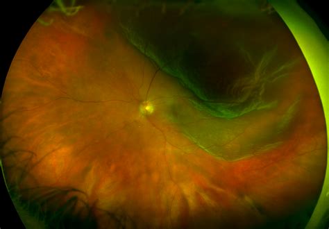 Retinal Detachment - Recognizing Pathology - Optos