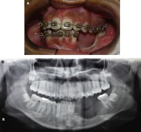 Autotransplantation Of Immature Third Molars And Orthodontic Treatment
