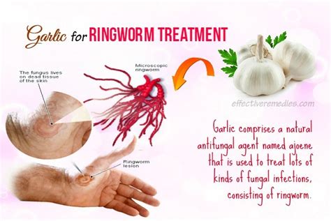 15 Best Natural Home Remedies For Ringworm In Humans