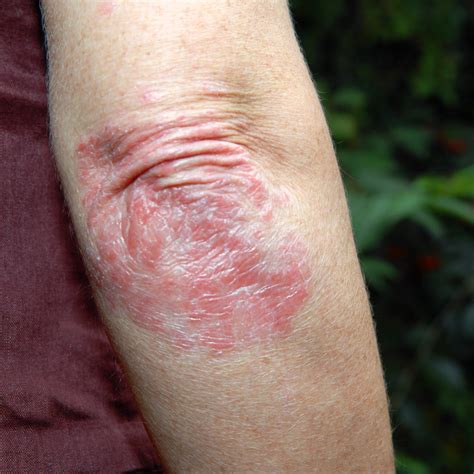 What Is Psoriasis Symptoms Types And Treatments Self
