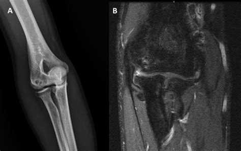 A Preoperative Elbow Plain Radiography Narrowing Of The Joint Space
