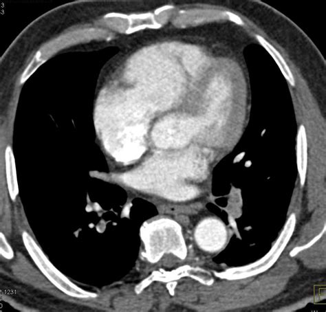 Extensive Pulmonary Embolism Chest Case Studies Ctisus Ct Scanning
