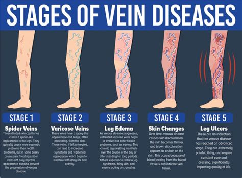 Venous Ulcers Ivein Clinic