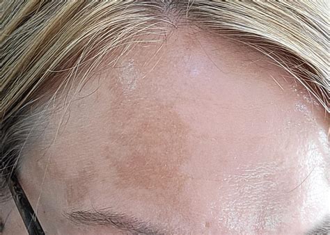 Advice Routine Suggestions For Melasma Or Hyperpigmentation On