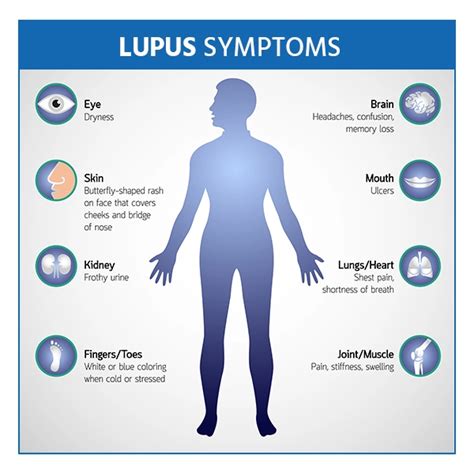 Understanding The Causes Diagnosis And Treatment Of Lupus