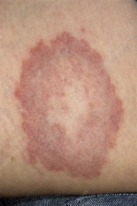 Granuloma Annulare On The Skin Stock Image C0029593 Science Photo
