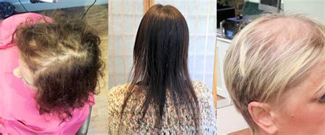 Recognising The Early Signs Of Female Hair Loss Living With Hair Loss