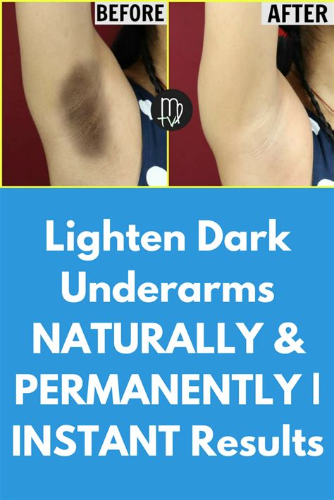 Lighten Dark Underarms Naturally And Permanently Instant Results Learn