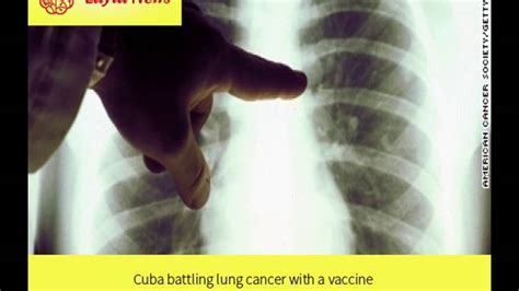 Cuba Battling Lung Cancer With A Vaccine By Cnn Youtube