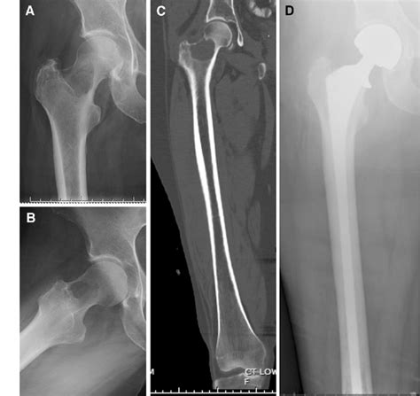 Standard Treatment For Impending Or Actual Femoral Neck Fracture This